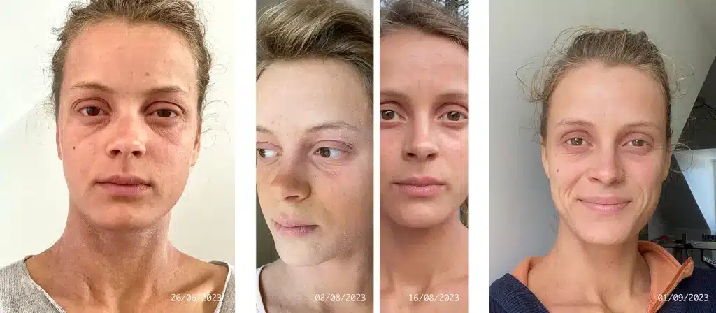 évolution de la peau de Barbara qui passe de très marquée par les stigmate de l'eczéma à une peau souple et plus lumineuse.